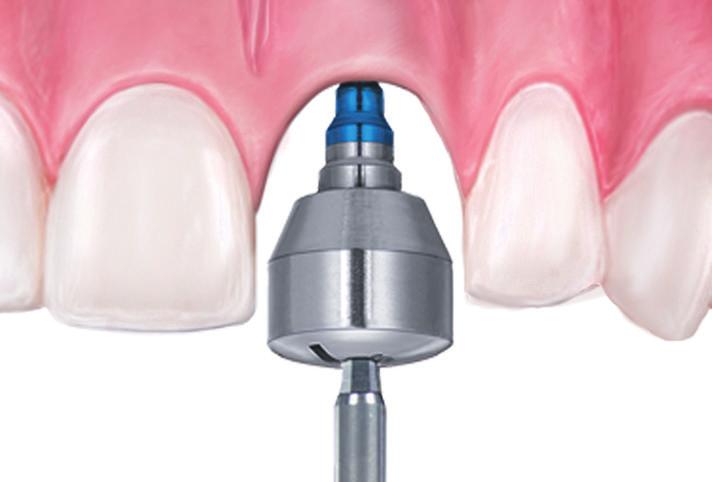 Implant And Abutment Level Impressions Pick-Up Impression Copings Certain Internal Connection is illustrated below. 1.