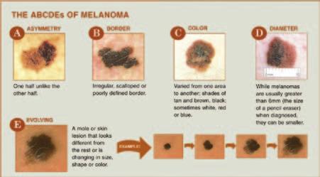 Skin Cancer Prevention, Early Detection & Screening Blistering sunburn in childhood and adolescence is an almost universal risk factor for melanoma in White and lighter-skinned populations.
