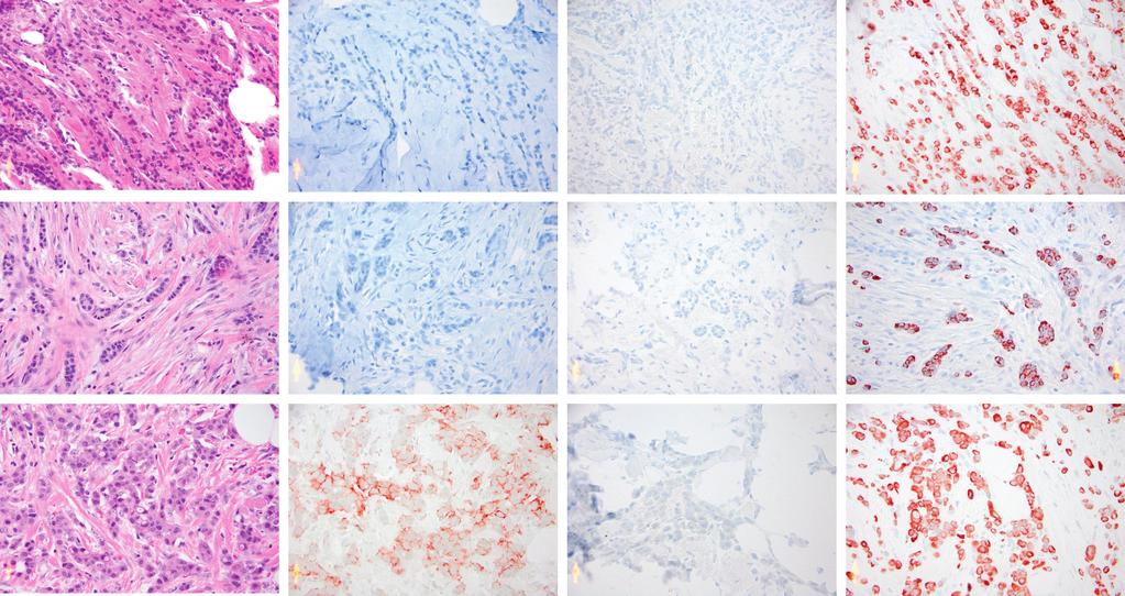 Khilko et al A B C D E F G H I J K L Figure 1. Examples of the staining patterns of each subtype of ILC.