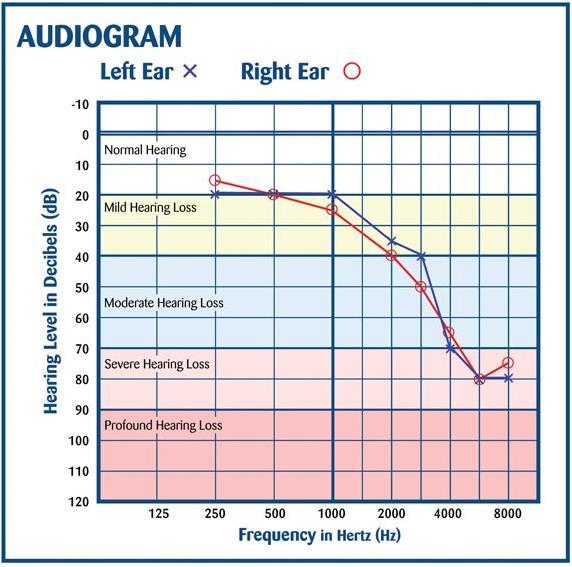 Age-related Hearing Loss