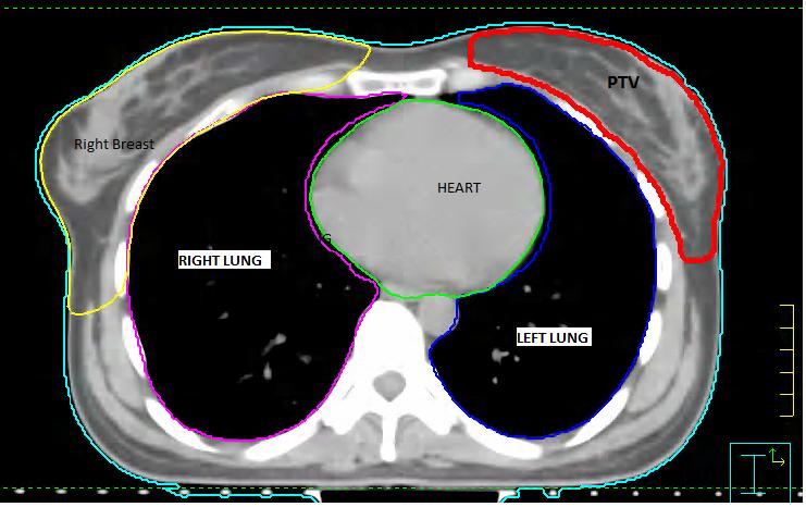 980 D. Adam et al. 3 Fig. 1 The main organ at risk contoured by the physician for breast cancer treatment planning: right lung, left lung, right breast and heart.