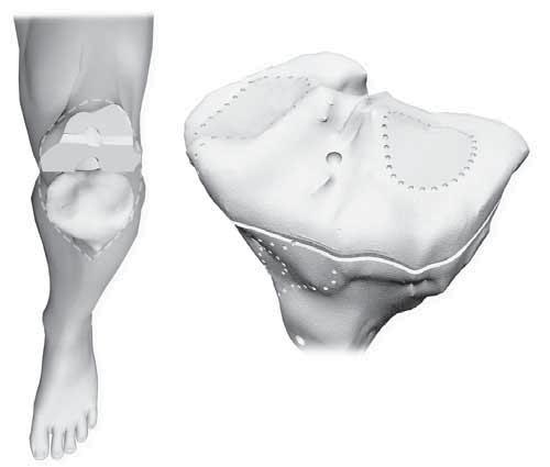 9 SECTION Position Tibial PSI Jig Position Tibial PSI Jig Look at the mating surfaces of the Tibial PSI jig on the tibia bone model or on the pre-operative planning (Fig. 11).
