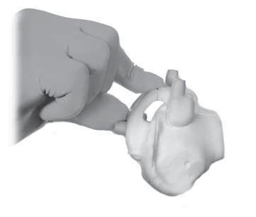 Avoid rotating the jig towards the posterior condyles, as this would cause excessive flexion Use the visual cues on the jig indicating the mechanical axis entry point,