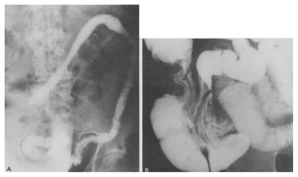 Pertinent history and possible predisposing factors in 4 of 8 patients with granulomatous colitis (Ge) and no involvement of the terminal ileum Age at onset y r 63 60 66 54 Possible predisposing