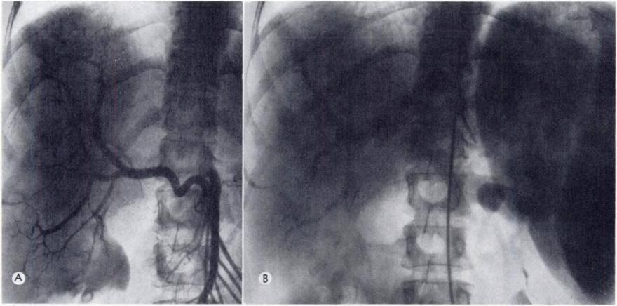 954 EKELUND ET AL. Fic. 2.-Angiography in 32-year-Old woman with ulcerative colitis since childhood.