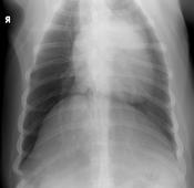 Atelectasis will mask any lesions in the down lung