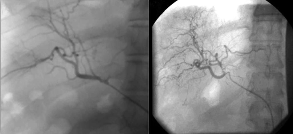 A B Figure 1 Hepatic artery characterization using angiograph of patients post transplantation after 6 mo (A) and after 12 mo (B).