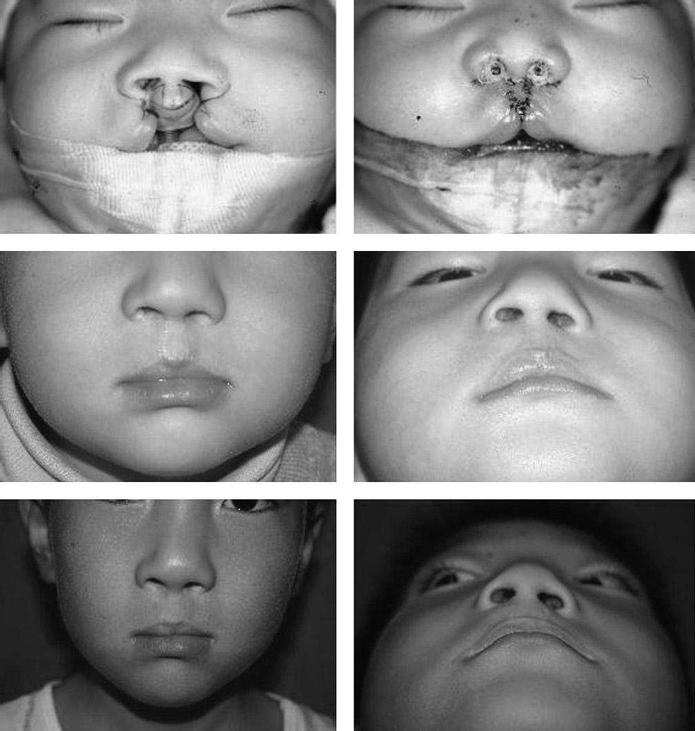 Upper lip height (sn-sto), mm Complete (N = 15) 7.1 (1.27) 13.0 (1.44) 14.4 (2.29) 17.0 (2.94) 18.8 (1.65) Incomplete (N = 17) 7.7 (1.25) 13.5 (1.76) 15.3 (1.93) 17.4 (2.16) 19.2 (2.