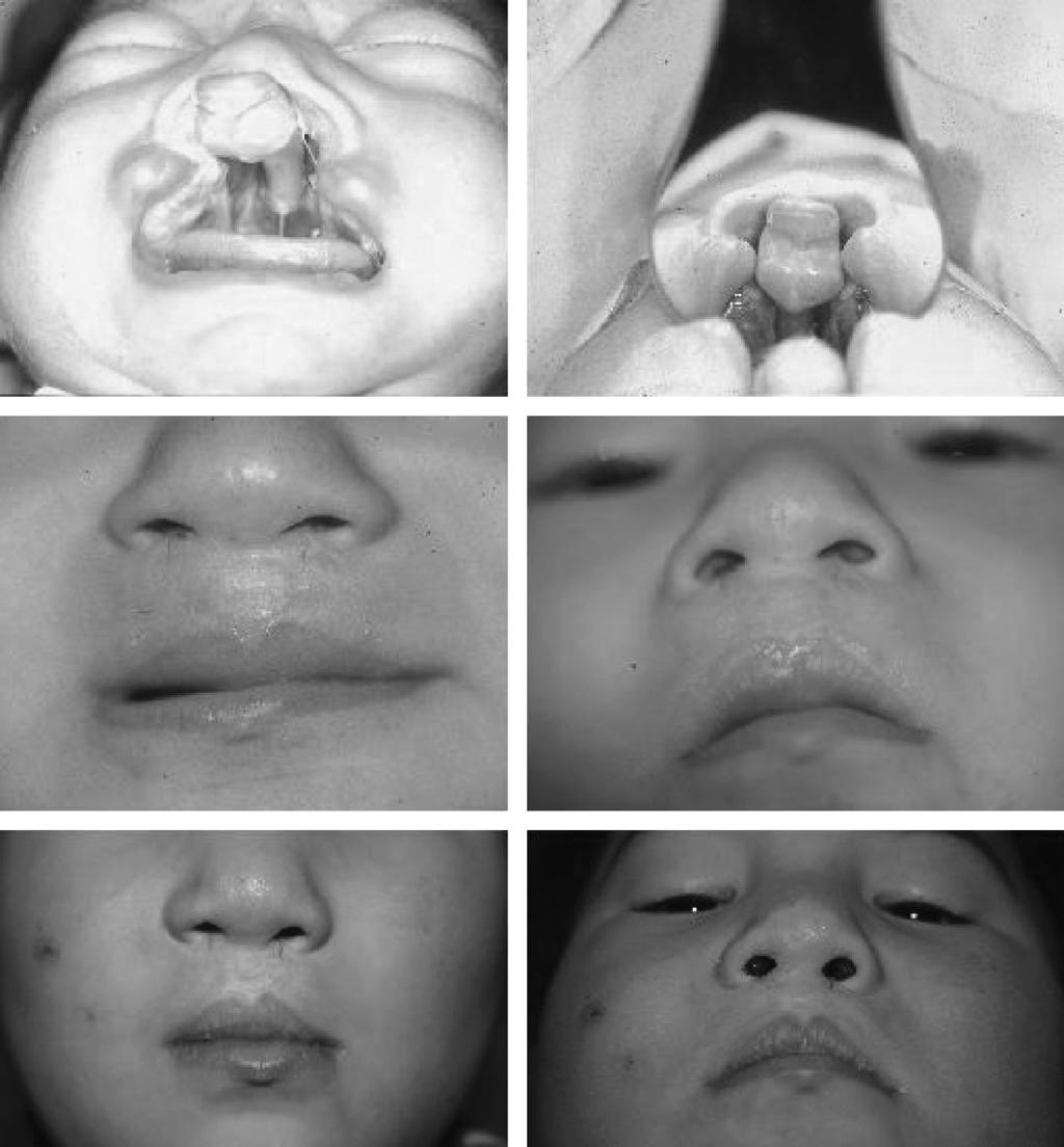 The Journal of Craniofacial Surgery & Volume 20, Number 5, September 2009 Mulliken in Bilateral Cleft Lip Repair FIGURE 6. Upper left, A 1-month-old infant with bilateral complete cleft lip.