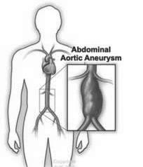 This leaflet tells you about treatment of abdominal aortic aneurysms. Your aneurysm may have reached the size where it is time to consider the pros and cons of intervention.