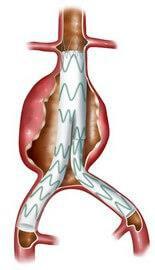 Treatments Broadly there are two types of treatment to prevent AAA rupture; stent grafting and open repair.