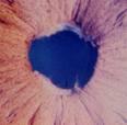 Choroidal effusion Cataract