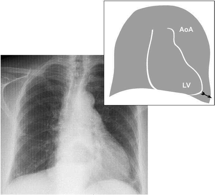 28 Ra-id Abdulla and D.M. Luxenberg Fig. 2.9 Aortic stenosis. The aortic arch (upper left border of the cardiac silhouette) is prominent with the evidence of left ventricular dilation.