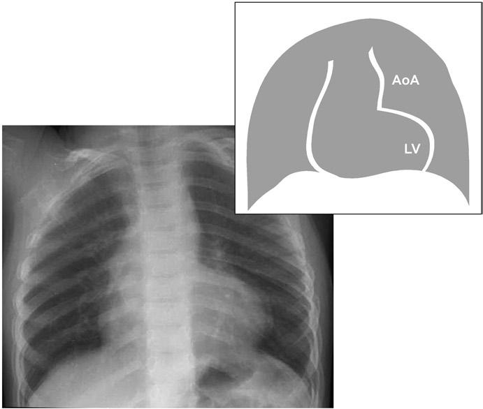 2 Cardiac Interpretation of Pediatric Chest X-Ray 29 Fig. 2.10 Coarctation of the aorta.