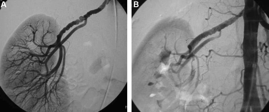 Percutaneous revascularization for renal artery stenosis 143 patients, although other factors (such as HTN, diabetes mellitus) also play a role. Connolly et al.