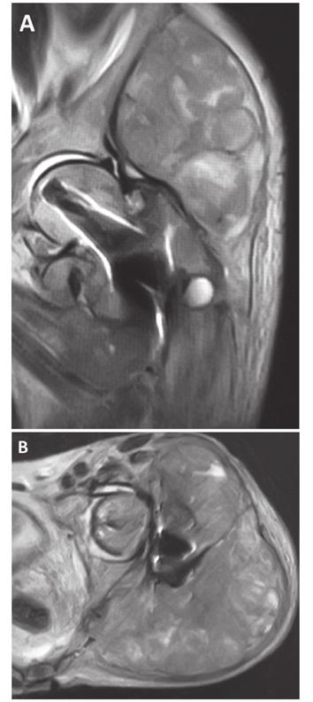 SUZUKI et al: BONE METASTASIS FROM A GIST 1815 Figure 1. Case one: Magnetic resonance imaging of the left hip.