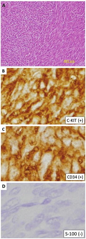 Immunohistochemical staining for (B) c KIT and (C) cluster of differentiation 34 revealing diffuse staining of the cell membrane. (D) Negative staining results obtained for S 100. Figure 2.