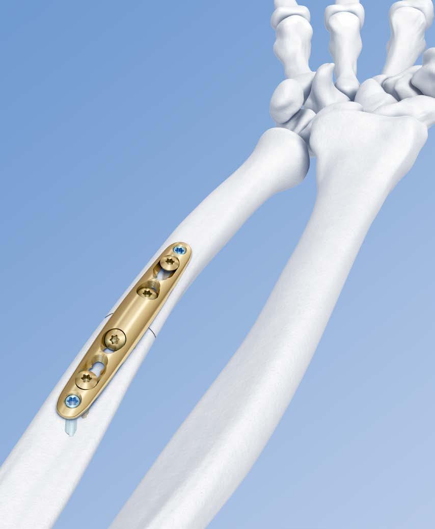 LCP Ulna Osteotomy System 2.7. Low profile angular stable fixation for ulna shortening osteotomies.