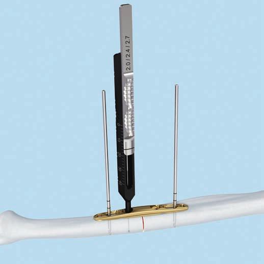 A Transverse Osteotomy 3a Insert cortex screws Instruments 314.467 Screwdriver Shaft, Stardrive, T8, self-holding 03.111.038 Handle with Quick Coupling 03.111.005 Depth Gauge for Screws B 2.0 to 2.