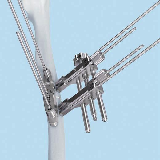 0 mm with drill tip, length 150 mm, Stainless Steel If additional stabilization is desired, apply the compression/ distraction instrument prior to performing the osteotomy cut.
