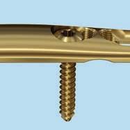 Locking screw (3) Symmetric plate design 1 2 3