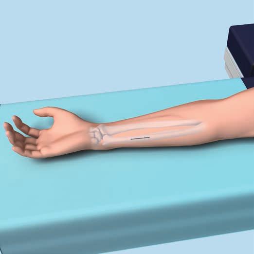 Preparation and Approach 1 Patient positioning Place the patient in a supine position with the forearm positioned on