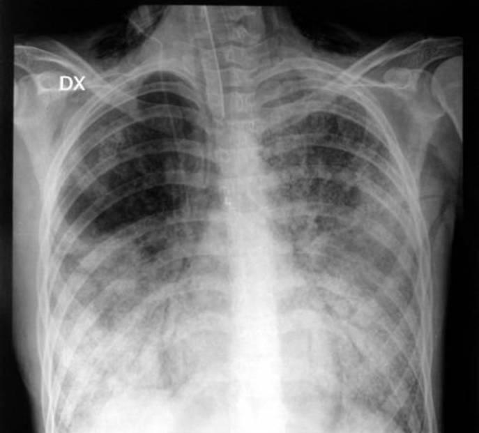 Figure 1 Figure 2 Figure 3 The medical history of the young patient was positive for pneumonia caused by