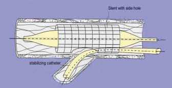 Bifurcated Stents AST SLK -View Main