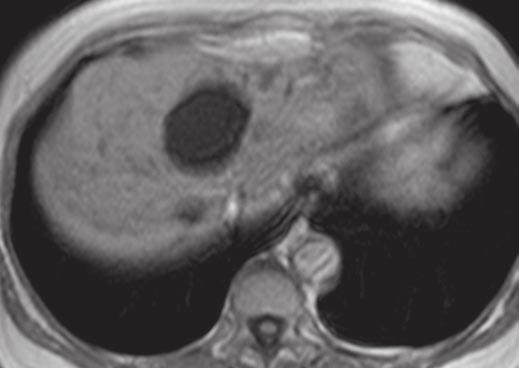 Sonography of Hepatic Steatosis E Fig. 9 (continued) 65-year-old woman with hepatic steatosis and simple cyst.