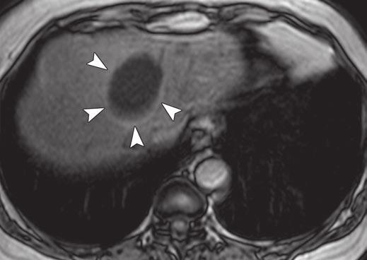, In-phase gradient-echo T1-weighted MR image shows cystic lesion with low signal intensity.