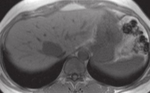 Sonography of Hepatic Steatosis D Fig. 1 (continued) 50-year-old woman with hepatic steatosis and hemangioma.