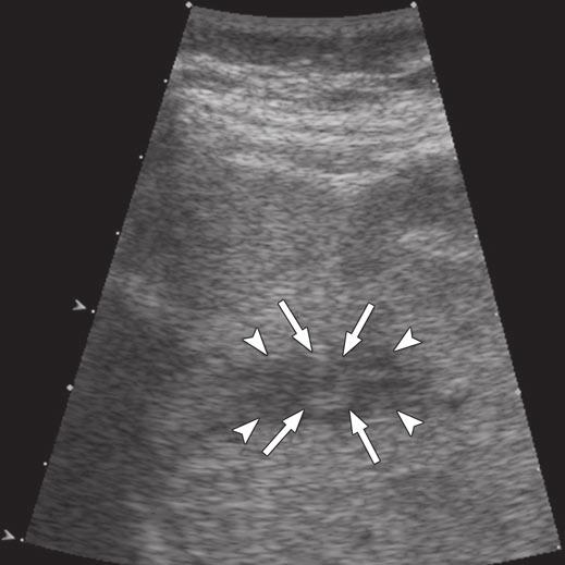 Finding indicates presence of peritumoral sparing of fatty infiltration. Fig.