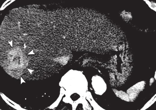 Hypoechoic mass (arrow) and wedge-shaped hypoechoic area (arrowheads) are present in right hepatic lobe.