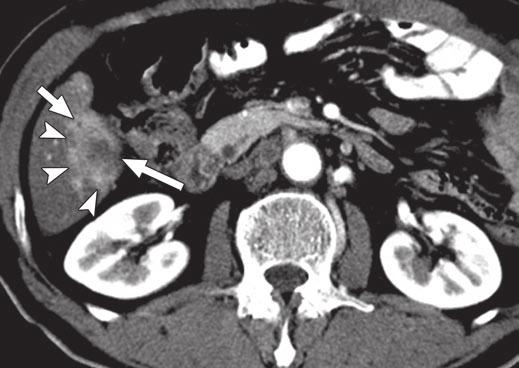 , Unenhanced T scan shows low hepatic attenuation suggestive of hepatic steatosis and low-attenuation mass (long arrow) with ill-defined geographic peritumoral hyperdense