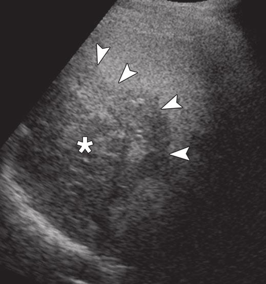 Small dotlike lowattenuation lesion (short arrow) is adjacent to mass.