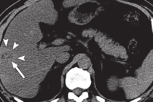 ill-defined hypoechoic area (arrowheads) in right hepatic lobe.