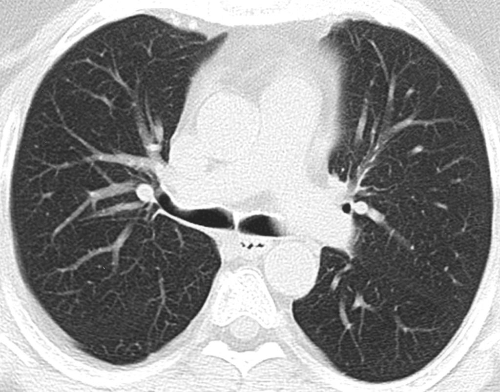 CT of ir Trapping in Tracheobronchomalacia (60%) of 10 patients had a history of asthma (n = 5) or emphysema (n = 1).