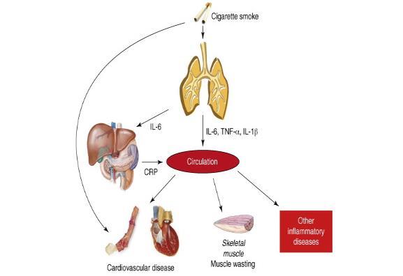 Exacerbations and systemic inflammation Cazzola M