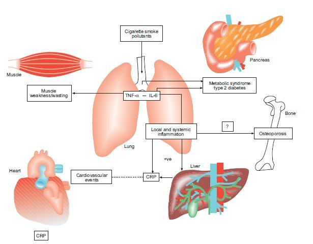 Comorbidities of COPD Fabbri LM et