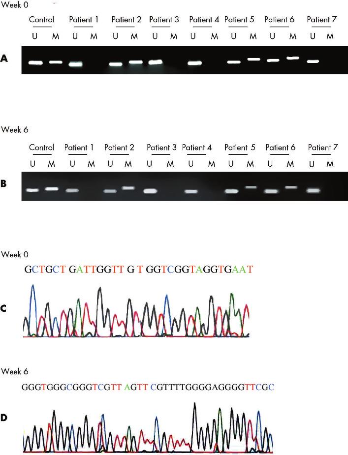 E-cadherin methylation and H pylori eradication 467 Figure 3 CpG island methylation at the E-cadherin gene in gastric mucosa from patients with dyspepsia without receiving Helicobacter pylori