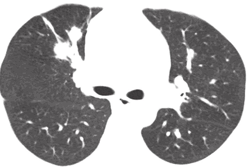 moksliniai tyrimai 4 A pav. Dešinio plaučio S3 apie bronchus matomos minkštųjų audinių tankio masės 5 pav. Tiesioginis infiltracinis limfomos peraugimas į krūtinės ląstos sieną.