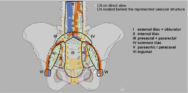 SHOULD THE TEMPLATE OF THE PRIMARY LYMPHATIC LANDING SITES OF THE PROSTATE BE REVISITED?