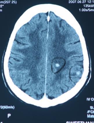 Brain metastases www.canceraustralia.