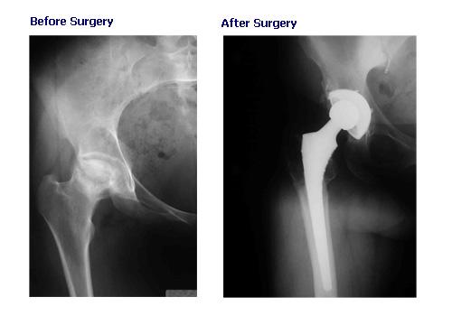 Total Hip Replacement Surgery On this page: Overview What is Total hip replacement (THA)?
