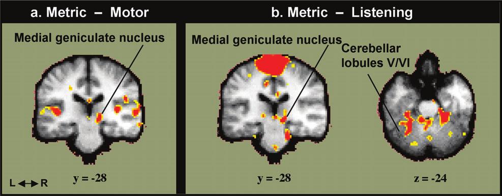 Figure 3. (a) Activation in the medial geniculate nucleus in the analyses of Metric dance minus Motor and (b) Metric dance minus music Listening.