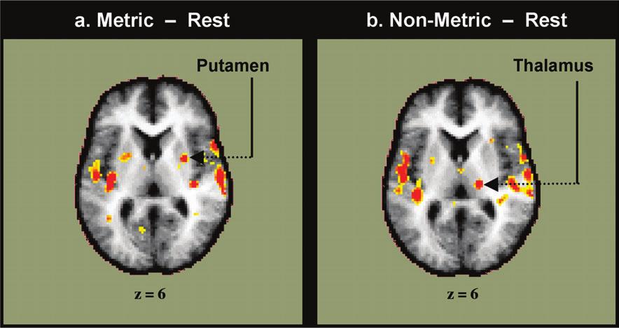Brown Figure 4. Reciprocal activation in the putamen and ventral thalamus in Metric and Non-Metric dance. The thalamic activation occurs at the junction of the ventral posterior and pulvinar nuclei.