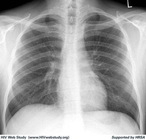 clinicalkey.com/topics/pulmonology/histoplasmosis.html. 02/22/2014 4) Mayo Clinic. Diseases and Conditions Histoplasmosis.