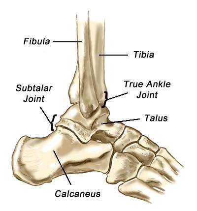Most ankle arthritis is caused by wear and tear which reduces the shiny cartilage that lines the joint causing bone to rub on bone which is painful.