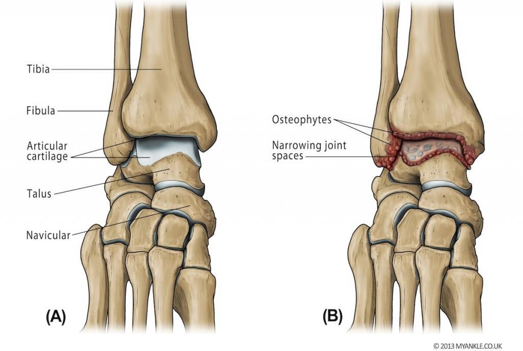 ) Early symptoms of ankle arthritis are pain and perhaps swelling and stiffness, especially after prolonged activity including standing or walking, or after high impact activities,