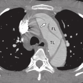 True-lumen collapse in aortic dissection. Part I. Evaluation of causative factors in phantoms with pulsatile flow. Radiology 2000; 214:87 98 3. Golledge J, Eagle K. cute aortic dissection.